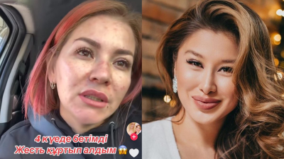 «Енді қалай емдеймін?» Әсел Асқардың жарнамасына сенген қыздың беті бөртіп кеткен (ВИДЕО)