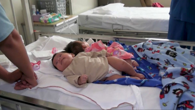 Перуде дәрігерлер сиам егіздерін ажыратты